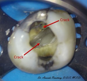 Real life example of a Cracked Tooth crown