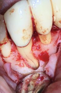 Real life example of a Cracked Tooth root