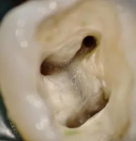 inside the root of a tooth