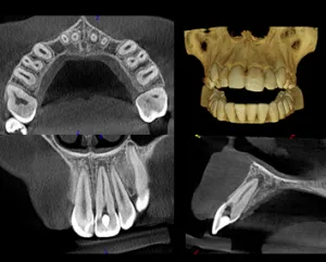 digital images of teeth used advanced technology at Capitol Endodontics